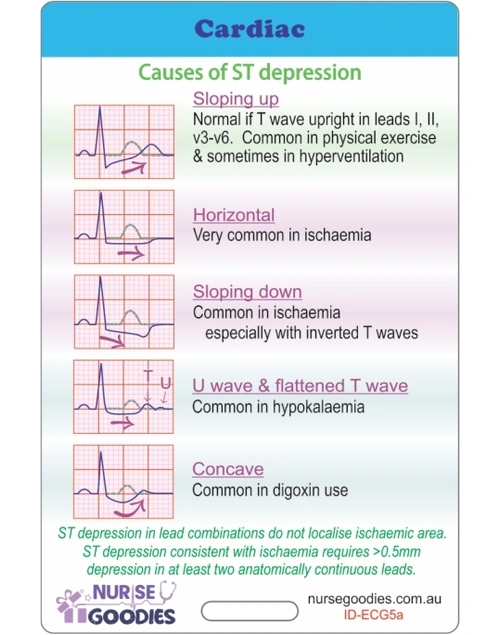 Sci-Ed CARDIAC ÃƒÂ¢Ã¢â€šÂ¬Ã¢â‚¬Å“ Causes of ST Depression